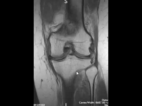 Knee MRI Scan of a Radial Meniscus Tear | First Look MRI
