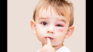 Treating insect bites in the eye ... Here are the ideal ways to avoid risks