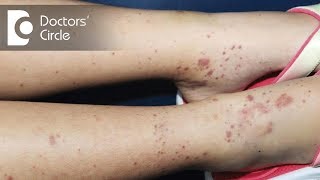 How to manage itchy skin & small black spots on arms & legs in 3 year old? - Dr. Varsha Saxena