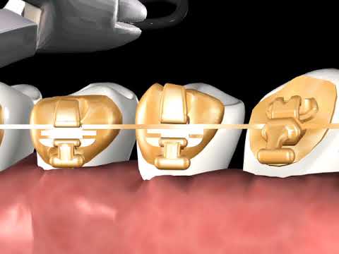 Incognito™ Appliance System Clinical Guide 02: Normal Elastic Tie
