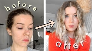 how I cover my acne // *skin picking edition*