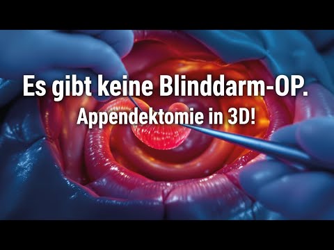 Wieso die Blinddarm OP KEINE Blinddarm OP IST - Appendektomie in 3D
