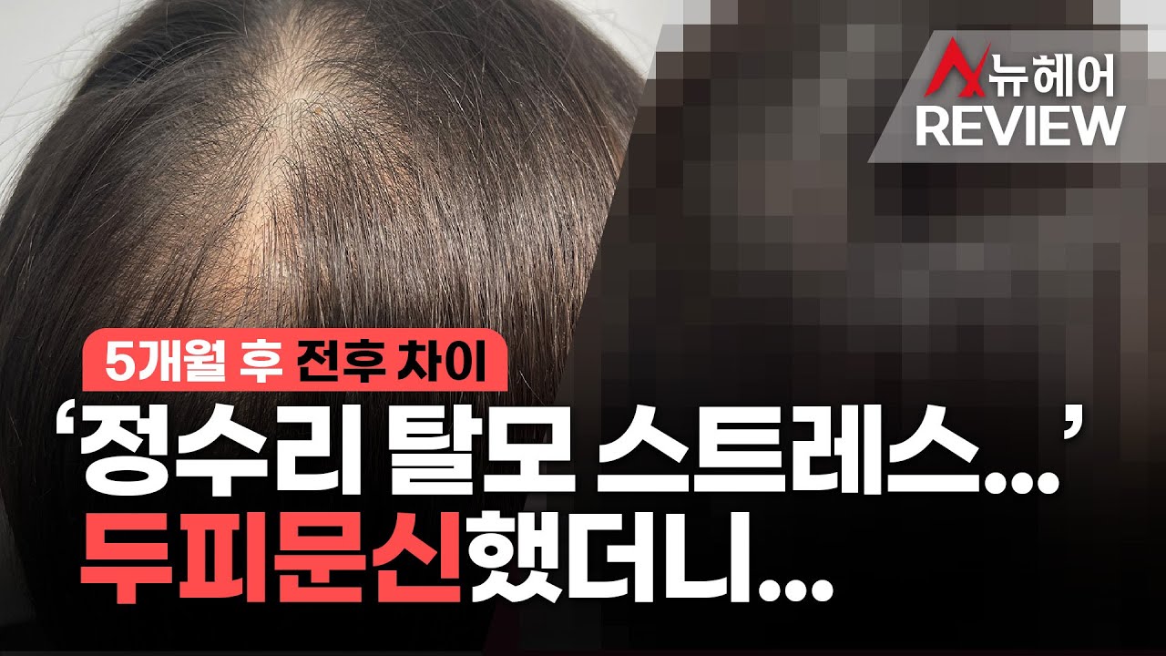 정수리탈모 가르마탈모 스트레스 때문에 두피문신했더니...ㅣ뉴헤어