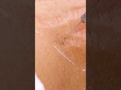Up close view of how laser stretch mark removal works! 😯 #shorts