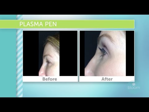 Non-Invasive Plasma Micro-needing Pen Treatments At Hermann Wellness