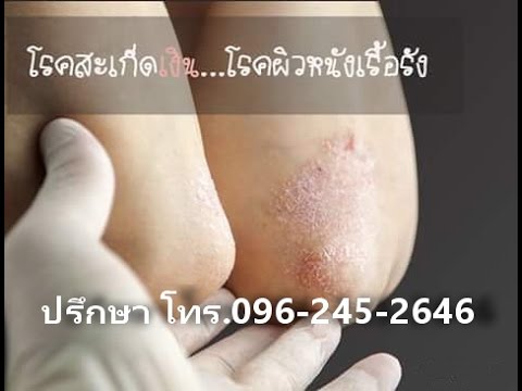 ผื่นแพ้, โรคสะเก็ดเงิน ยาโรคสะเก็ดเงินจากประเทศอิสราเอล