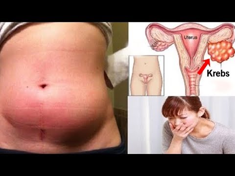 BPH behandelt Pillen Kerzen und Tabletten für die Behandlung von Prostatitis