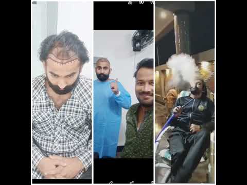 Fue hair transplant 0323 6375419