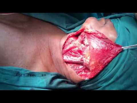 Oral cancer treatment surgery