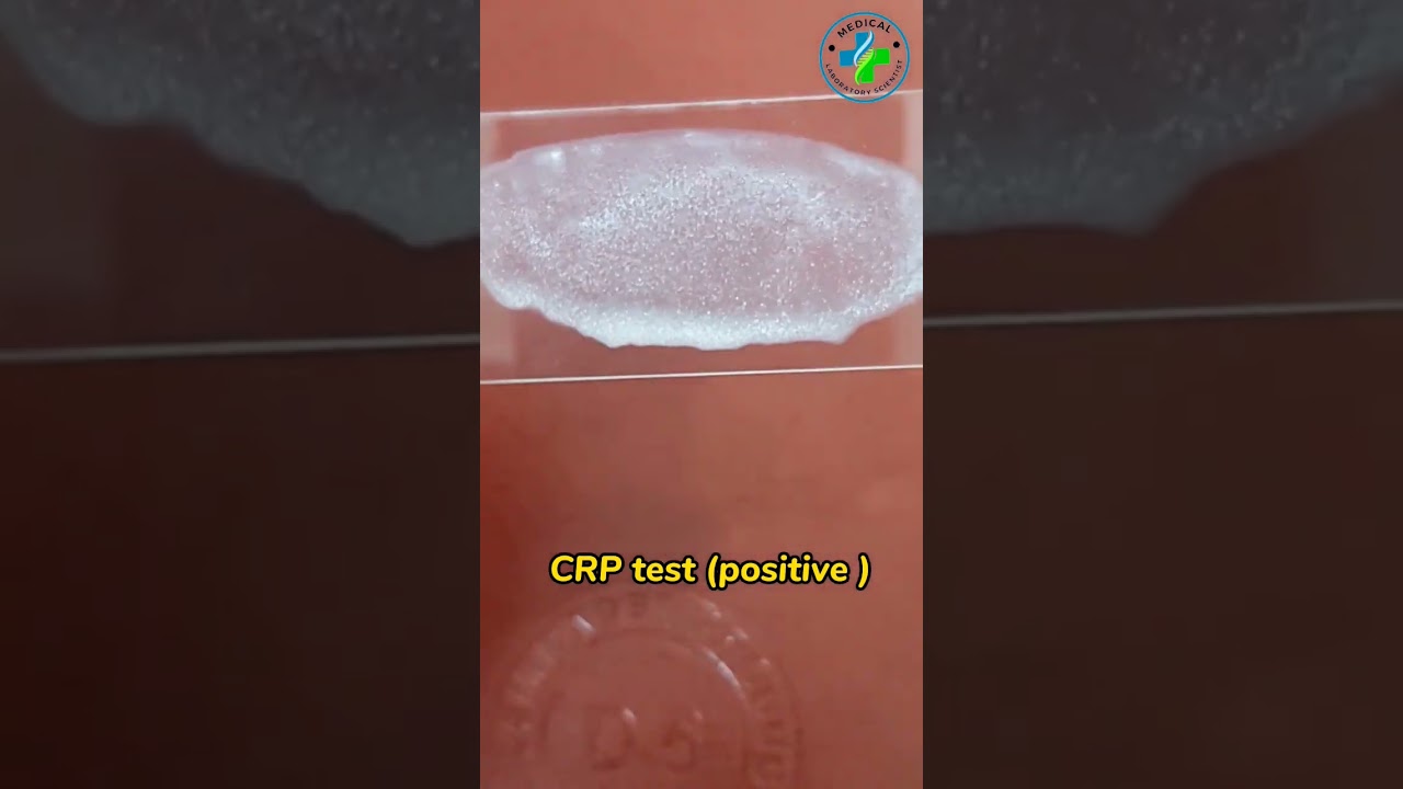 CRP test | what is CRP | C reactive protein test | CRP latex test|CRP qualitative test|CRP positive