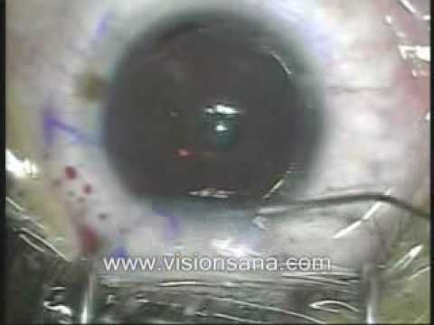 Noutăți de oftalmologie în tratamentul distrofiei retiniene