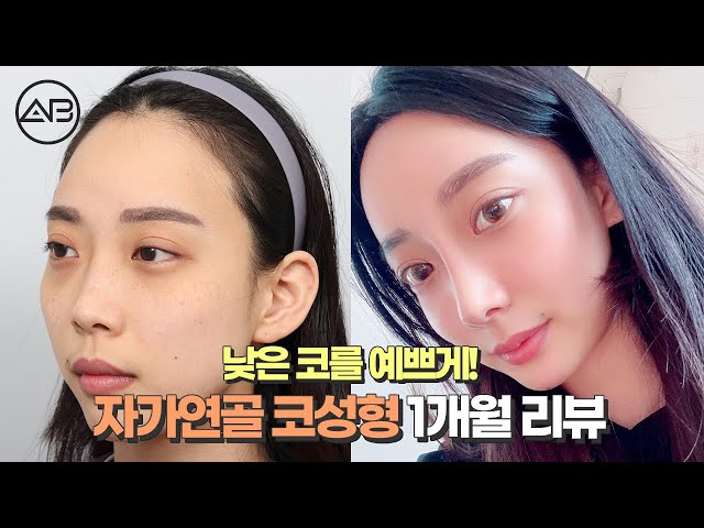에이비성형외과의원_코성형_낮은코 에이비성형외과의원_코성형_낮은코