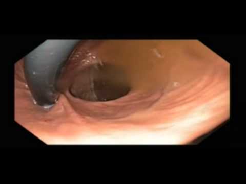 Stomach, PostSurgical Anatomy, Vertical Banded Gastroplasty