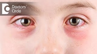 Symptoms of eye allergies - Dr. Sriram Ramalingam