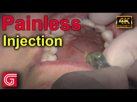 How to Give Painless Dental Injection