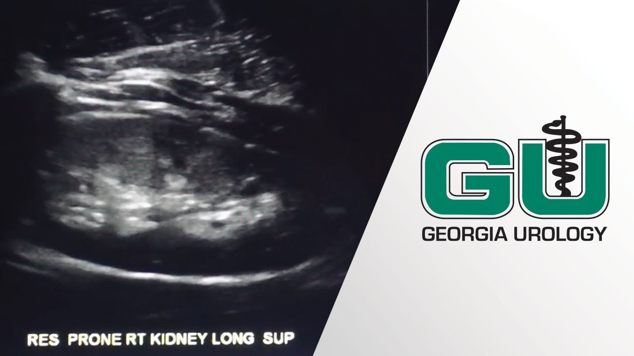 Extracorporeal Shockwave Lithotripsy (ESWL) For Kidney Stones in Children