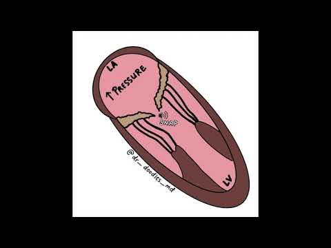 Mitral Stenosis Opening Click