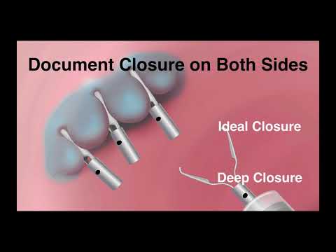 Clip closure •