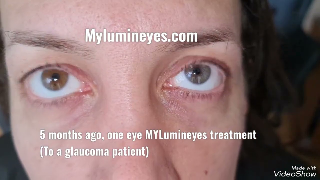 Cirurgia de mudança de cor dos olhos a laser (Lumineyes) em um paciente com glaucoma! @eyecolorchange