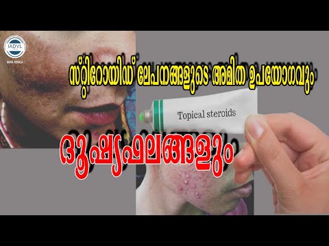 Topical steroid abuse and its adverse effects സ്റ്