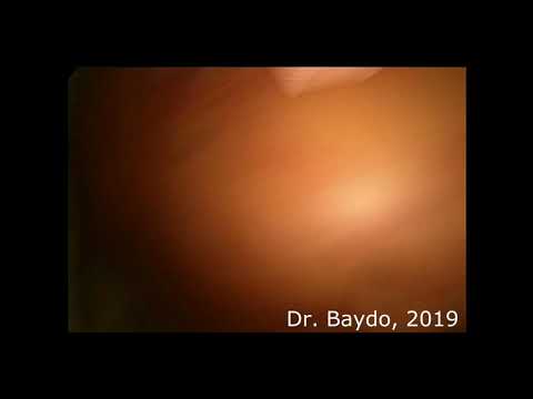 Laparoscopic Removal of Gastric GIST