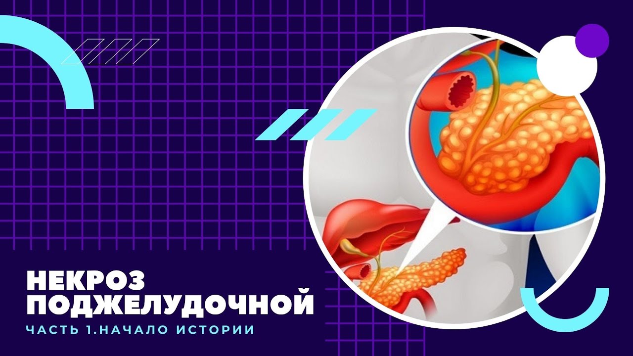 Некроз поджелудочной железы часть 1