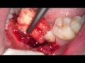 48 tooth extraction with microscop (удаление зуба мудрости) 