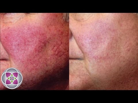 download lagu mp3 mp4 Dermalex Rosacea Treatment, download mp3 Dermalex Rosacea Treatment free download, download mp3 Dermalex Rosacea Treatment