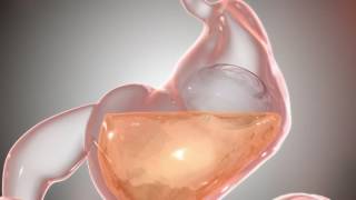 Obalon: Non-Surgical Weight-Loss