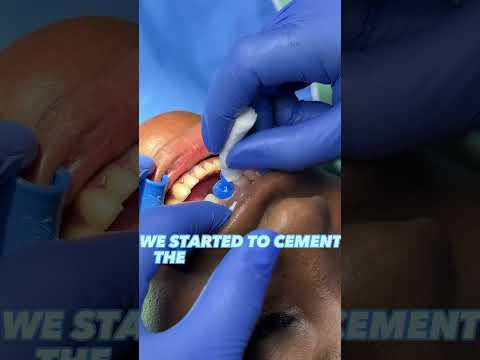 Composite vs Porcelain Veneers BIG Difference