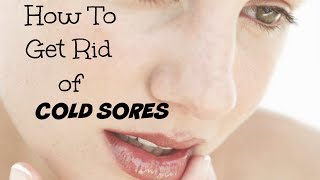 How To Get Rid of Cold Sores