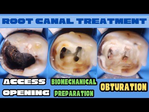 Root Canal Treatment - Mandibular Molar | Access Opening | Biomechanical Preparation | Obturation