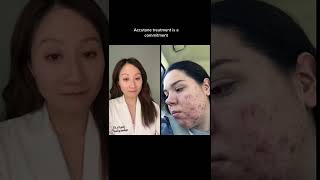 Doctor Reacts to Acne Transformation on Accutane #SHORTS