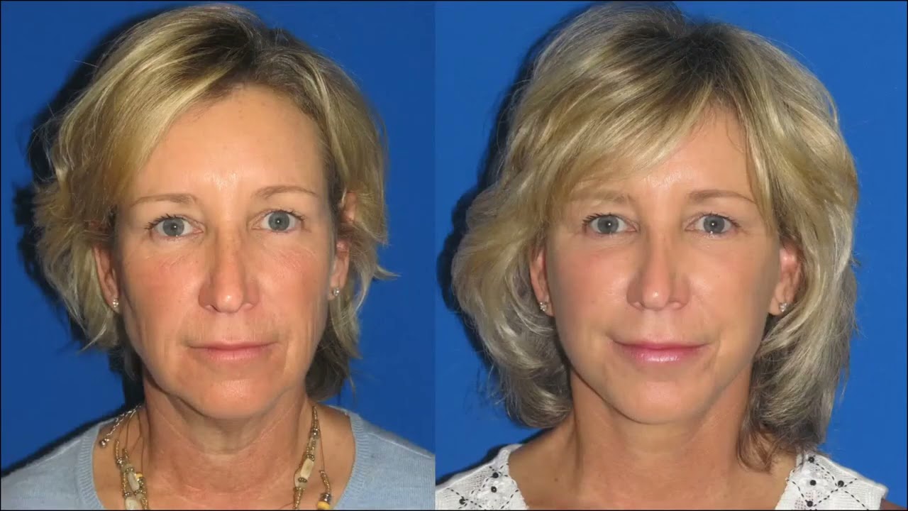 Considering a Facelift? Everything You Need to Know | Edina Plastic Surgery Webinar