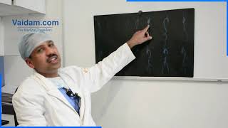 Bentall Procedure Explained by Dr. Sanjeev Kumar Singla of Medanta Hospital, Gurgaon