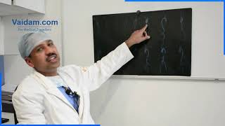 Procedimento de Bentall Explicado pelo Dr. Sanjeev Kumar Singla do Hospital Medanta, Gurgaon