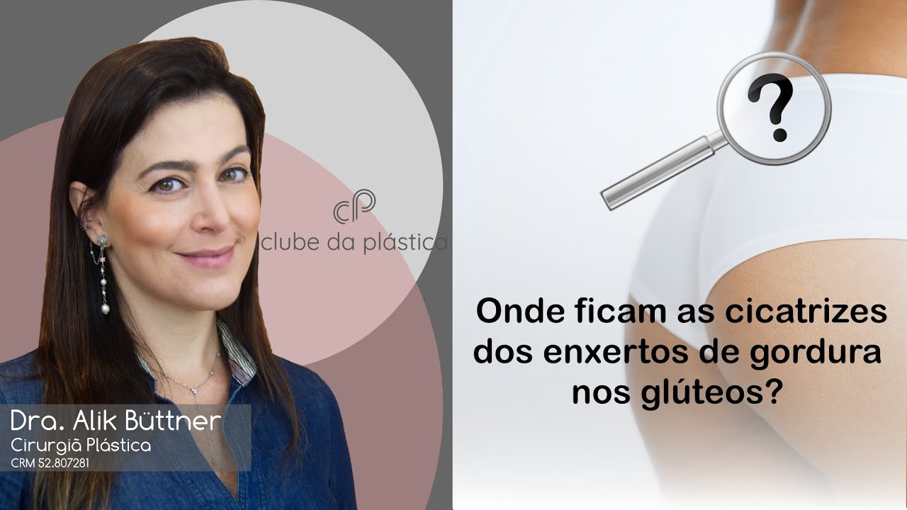 Clube da Plástica: Onde ficam as cicatrizes dos enxertos de gordura nos glúteos?