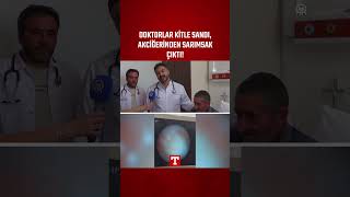 Nefes Alamıyordu! Doktorlar Kitle Sandı, Akciğerinden Sarımsak Çıktı! 
