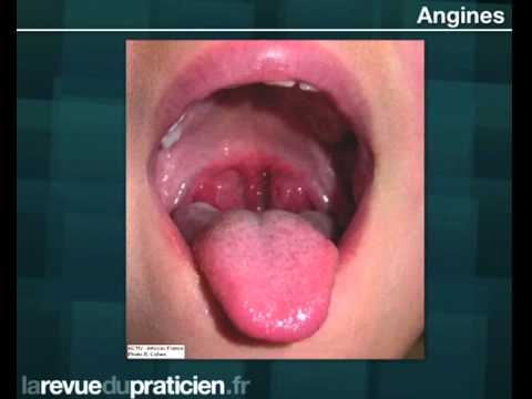 Description des angines et leurs complications 1/2