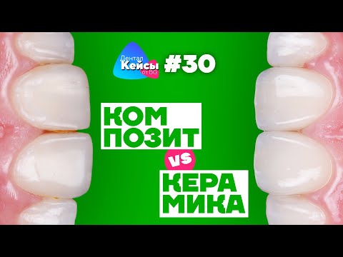 Композит VS Керамика | Дентал Кейсы от BG #30