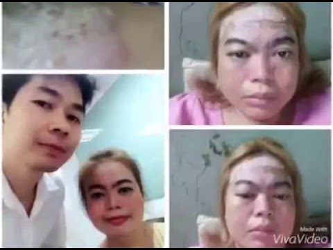 แผ่นเล็บกลาก โรคผิวหนังภูมิแพ้ในเด็ก 7 ปี