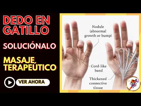 ❗How to relieve trigger finger. Stenosing tenosynovitis.