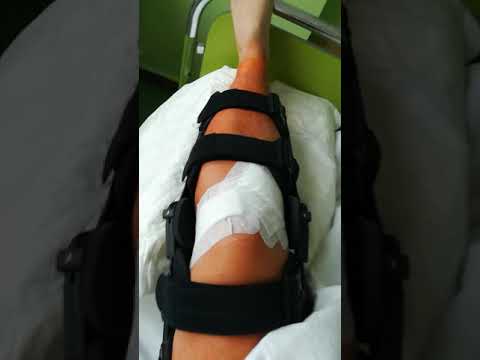 Jak leczyć kość w stopie w palucha w domu Wpada modzele na palcach