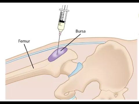 Greater Trochanteric Bursa Injection