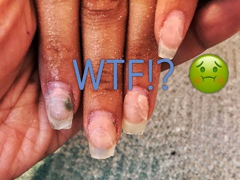 Folk remedyo para sa mga halamang-singaw ng kuko gamit suka Fungus paa, tradisyonal na gamot