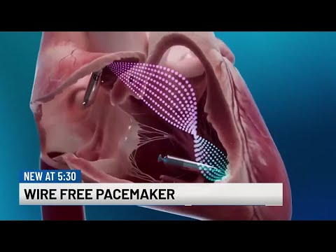 The new “no surgery, no wires” pacemaker