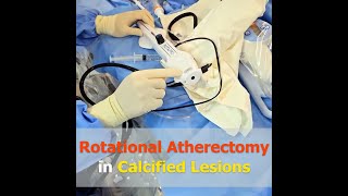 Download lagu [SUB]Rotational Atherectomy in Calcified Lesions (RotaPro) mp3