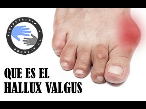 Aprende Todo Lo Necesario Acerca del Juanete o Hallux Valgus