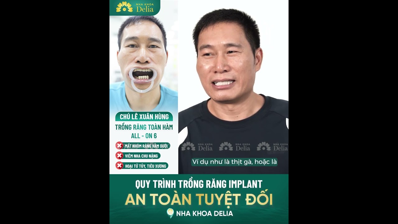 Delia_Ads Trồng răng Implant