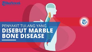 Osteopetrosis, Kondisi Herediteri ketika Osteoklas Gagal untuk Menyerap Tulang yang Belum Matang